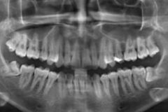 procedure-img2-300x169-1